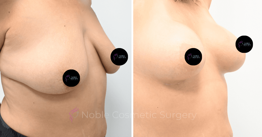 BREAST-AUGMENTATION-CASE-12478 | Before and After Breast