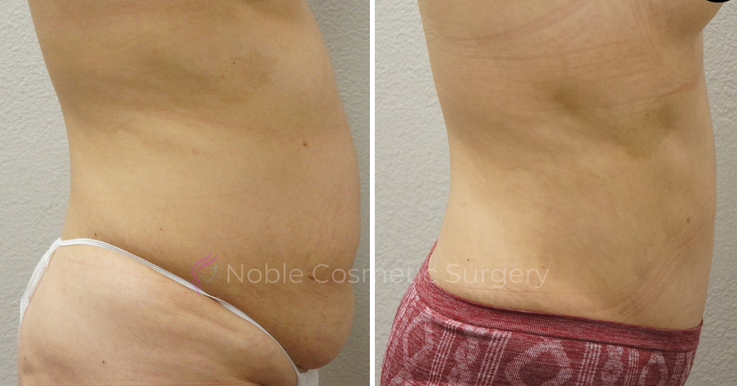 TUMMY-TUCK-CASE-00049 | Before and After Abdominoplasty 1