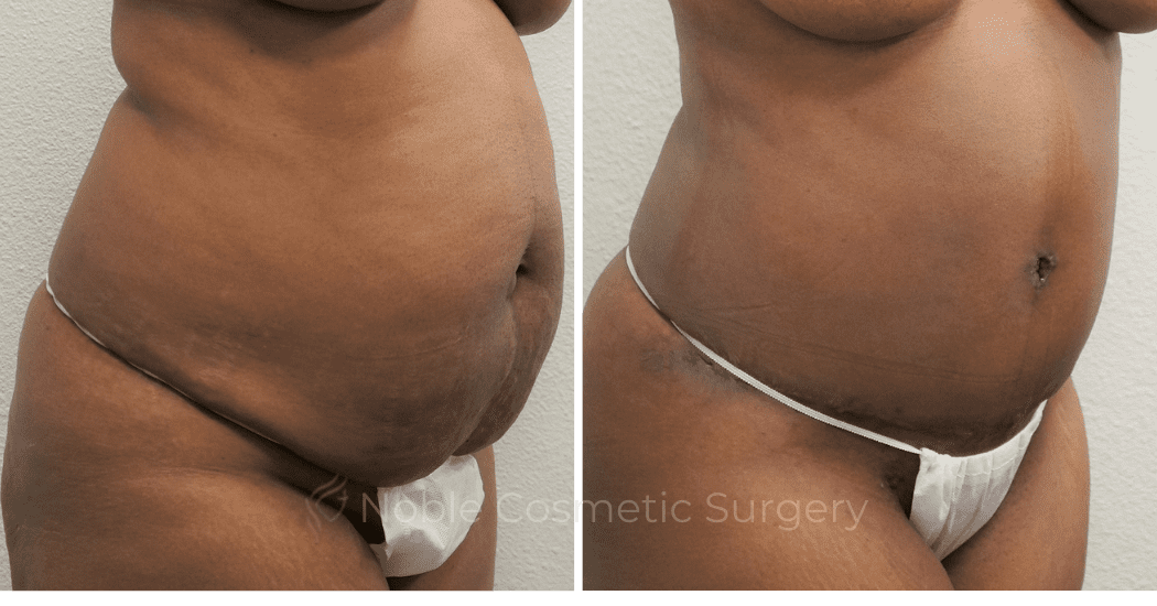 TUMMY-TUCK-CASE-00306 | Before and After Abdominoplasty 2
