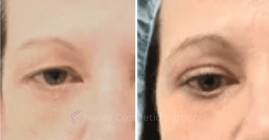 BLEPHAROPLASTY-CASE-20259 | Before and After Face