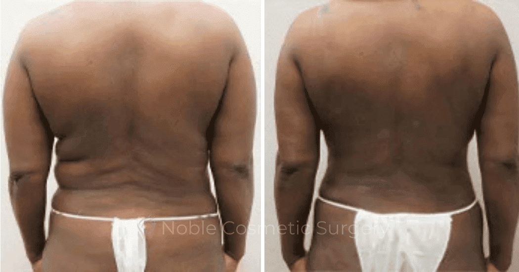 Back-Lift-Case-00254 | Before and After Back Lift 1