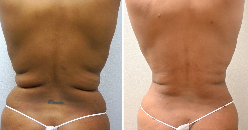 TUMMY-TUCK-CASE-00033 | Before and After Abdominoplasty 3