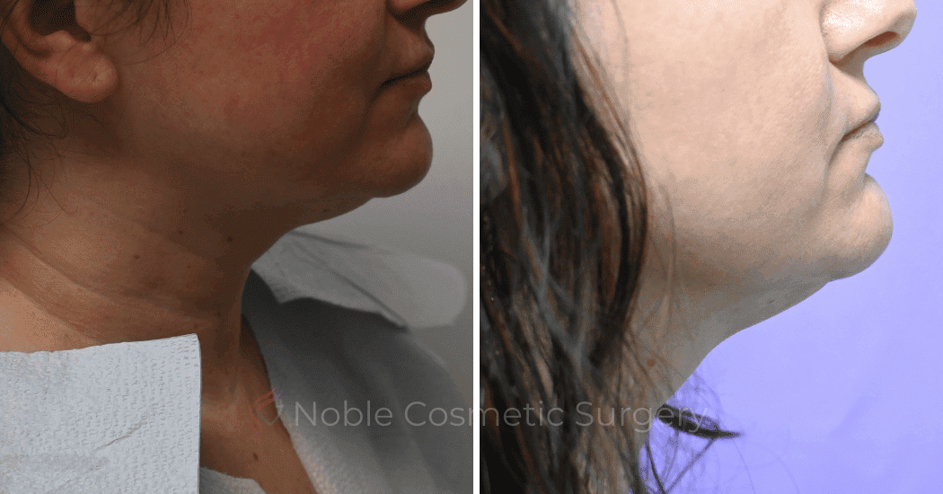 LIPOSUCTION-SUBMENTAL-19131 | Before and After Face