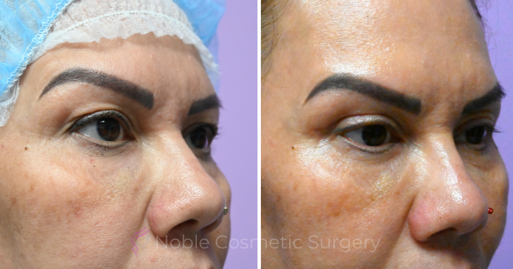 Case--20485 | Before and After Blepharoplasty 3