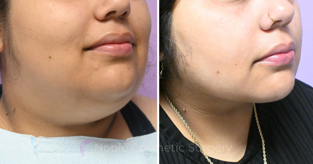 Case--10492 | Before and After Chin Liposuction 3