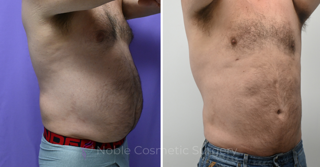 Case---13711 | Before and After Male Liposuction 3