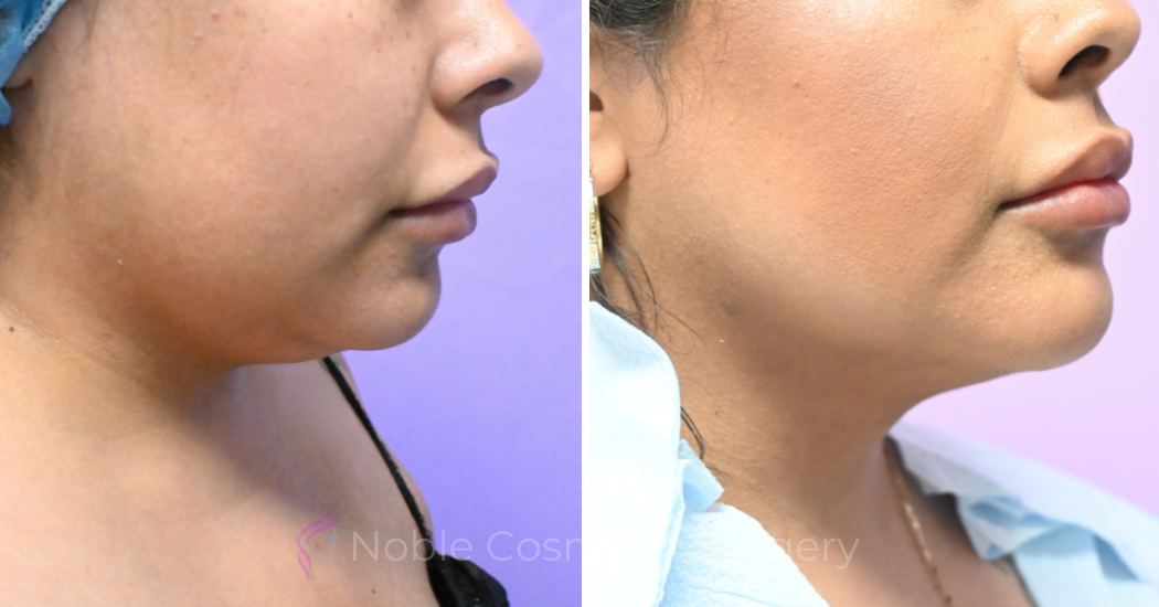 Case--20274 | Before and After Chin Liposuction 3