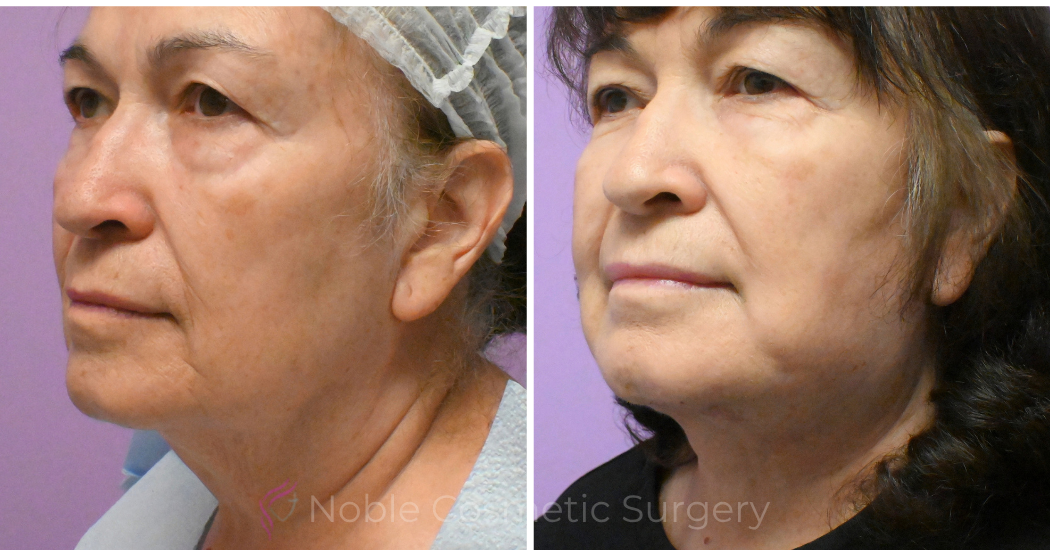 Case--20618 | Before and After Facelift 2