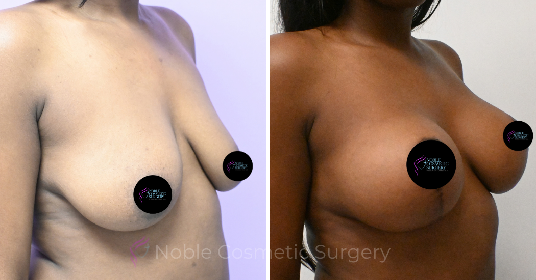 Case--5094 | Before and After Breast Augmentation with Lift 4