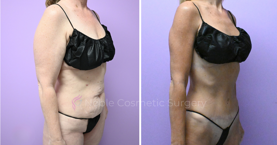 -20309 | Before and After Abdominoplasty 3