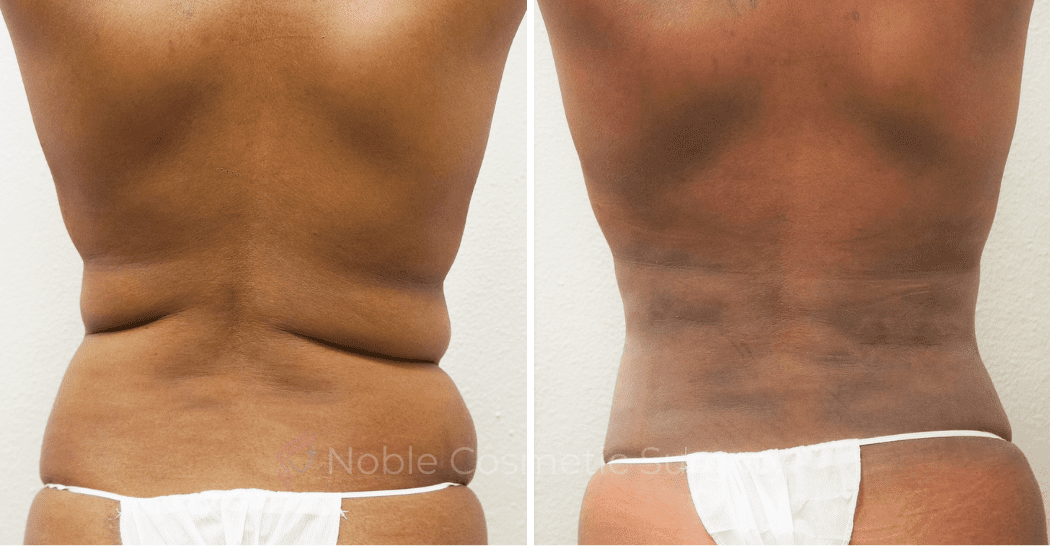 TUMMY-TUCK-CASE-00306 | Before and After Abdominoplasty 3