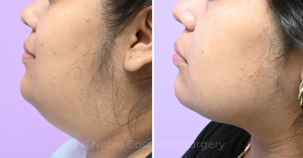 Case--10492 | Before and After Chin Liposuction 4