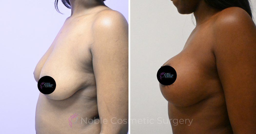 Case--5094 | Before and After Breast Augmentation with Lift 3
