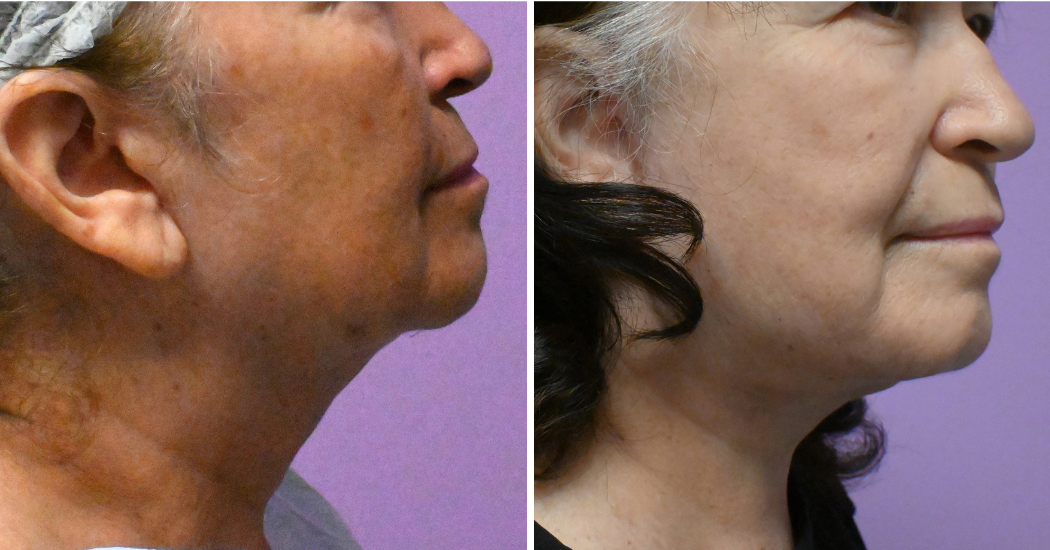 Case--20618 | Before and After Facelift 4