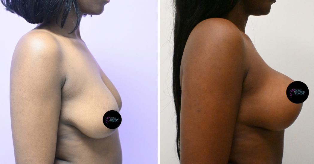 Case--5094 | Before and After Breast Augmentation with Lift 5