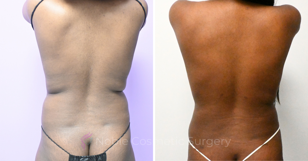Case--20347 | Before and After Abdominoplasty 5