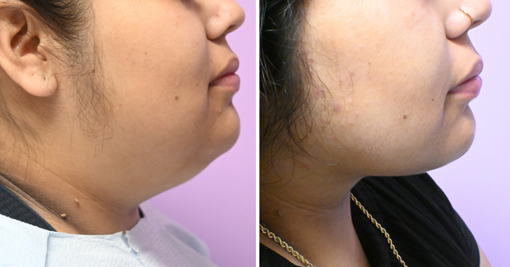 Case--10492 | Before and After Chin Liposuction 5