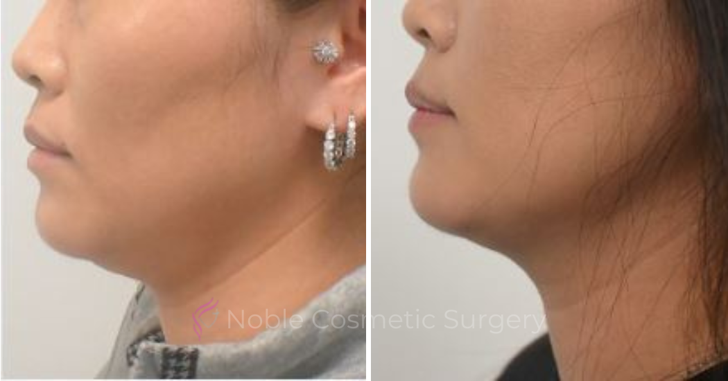 KYBELLA-CASE-00300 | Before and After Kybella 1