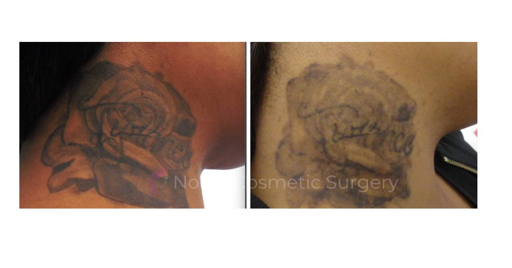 LASER-TATTOO-REMOVAL-CASE-00002 | Before and After Non-Surgical