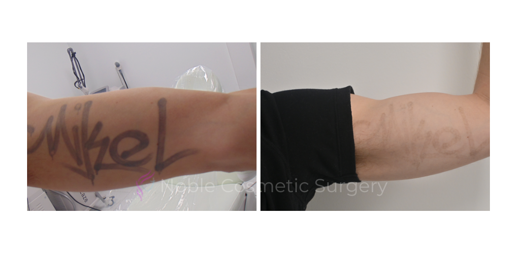 LASER-TATTOO-REMOVAL-CASE-00004 | Before and After Non-Surgical
