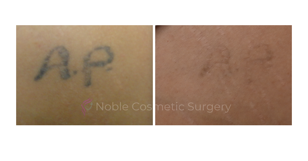 LASER-TATTOO-REMOVAL-CASE-00003 | Before and After Non-Surgical