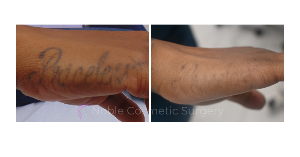 LASER-TATTOO-REMOVAL-CASE-00006 | Before and After Non-Surgical