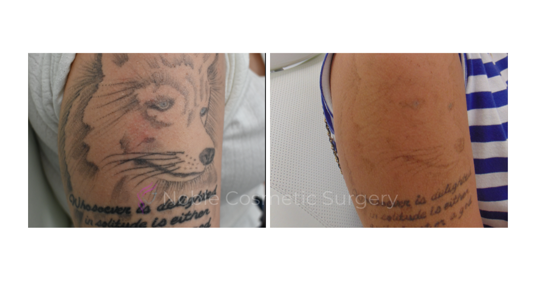 LASER-TATTOO-REMOVAL-CASE-00015 | Before and After Laser Tattoo Removal 1
