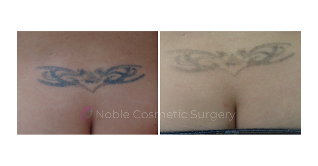 LASER-TATTOO-REMOVAL-CASE-00016 | Before and After Laser Tattoo Removal 1