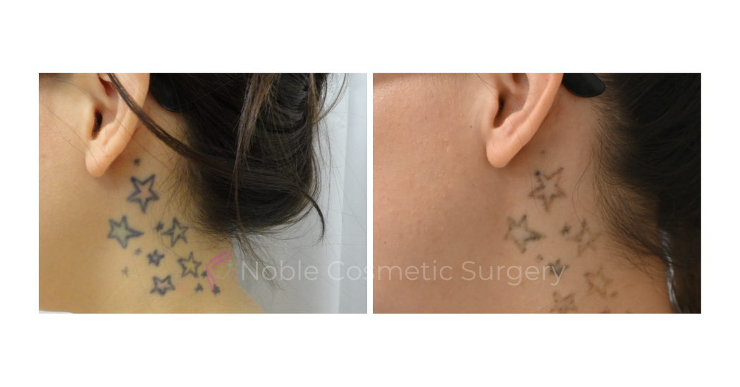 LASER-TATTOO-REMOVAL-CASE-00017 | Before and After Laser Tattoo Removal 1