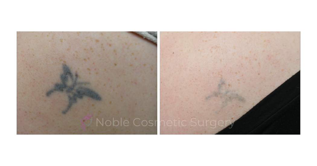 LASER-TATTOO-REMOVAL-CASE-00018 | Before and After Laser Tattoo Removal 1
