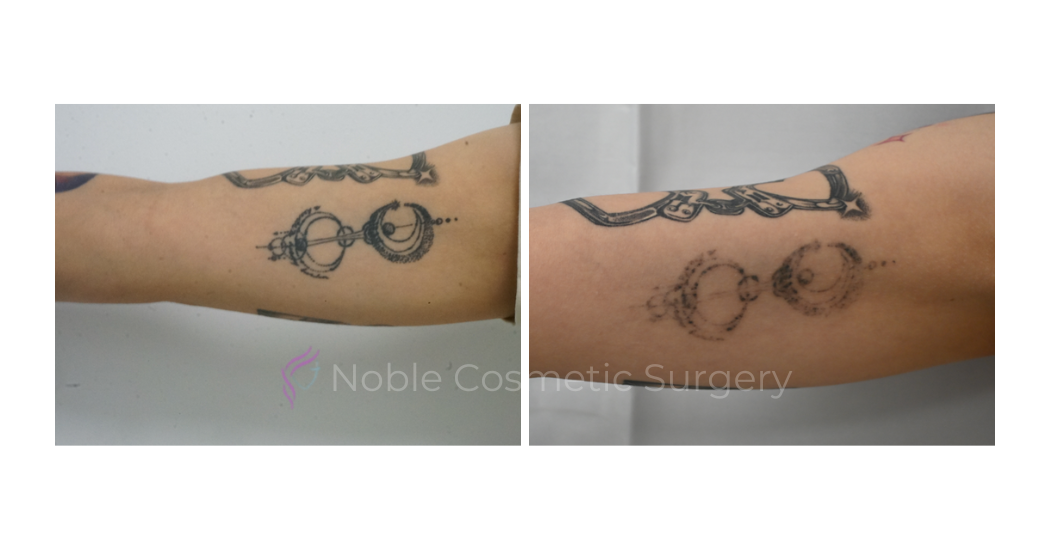 LASER-TATTOO-REMOVAL-CASE-00019 | Before and After Laser Tattoo Removal 1