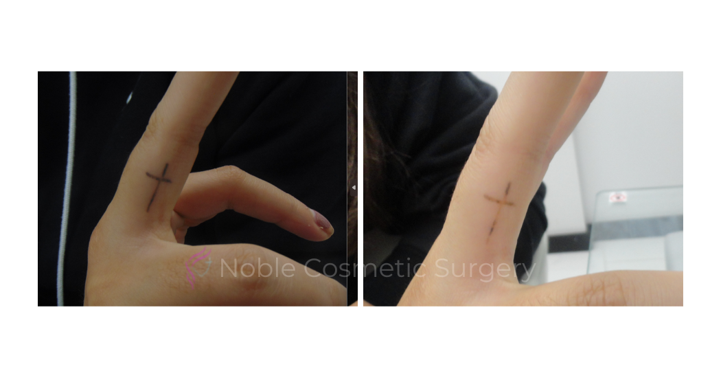 LASER-TATTOO-REMOVAL-CASE-00020 | Before and After Laser Tattoo Removal 1