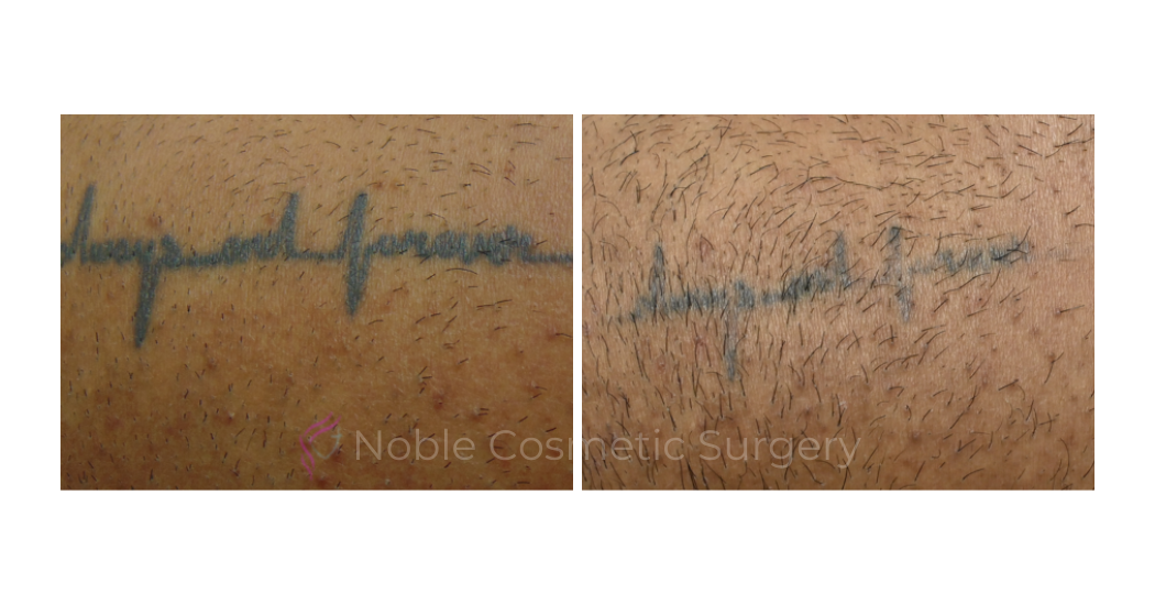 LASER-TATTOO-REMOVAL-CASE-00021 | Before and After Laser Tattoo Removal 1
