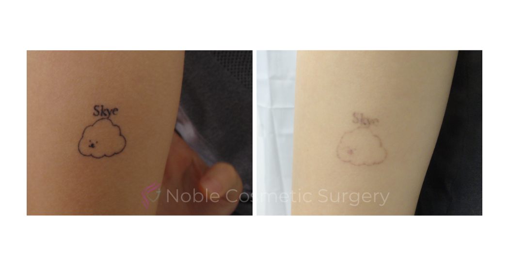 LASER-TATTOO-REMOVAL-CASE-00022 | Before and After Laser Tattoo Removal 1