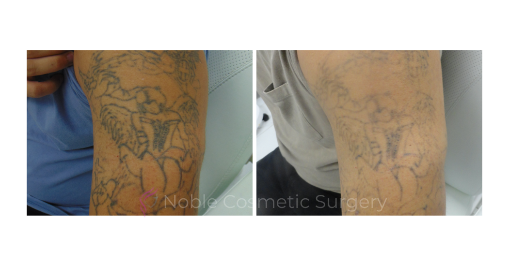 LASER-TATTOO-REMOVAL-CASE-00023 | Before and After Laser Tattoo Removal 1