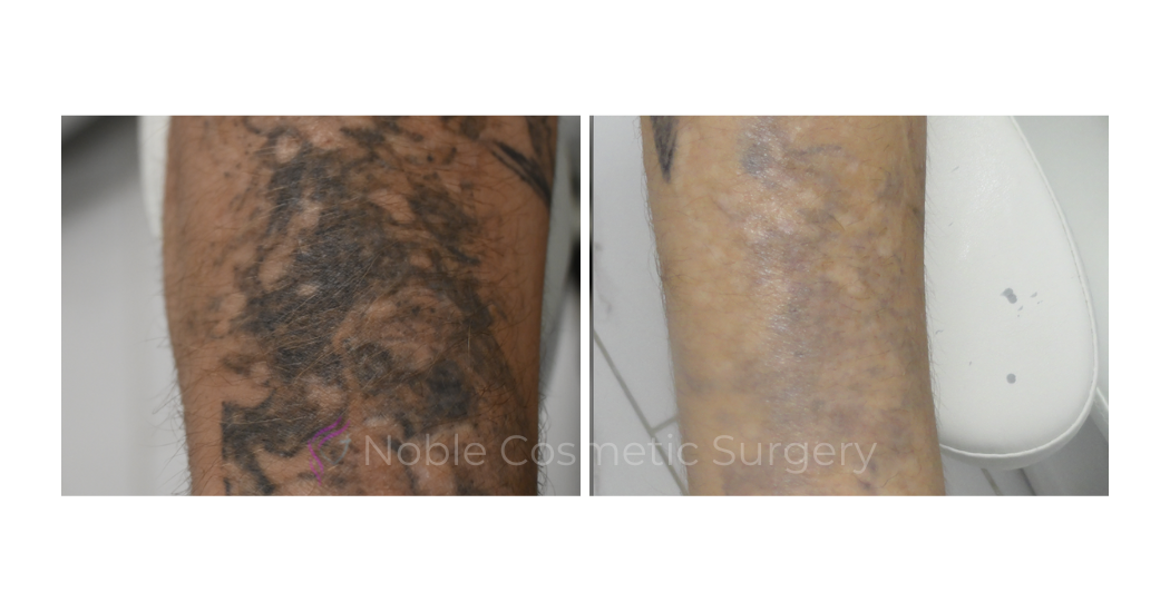 LASER-TATTOO-REMOVAL-CASE-00025 | Before and After Laser Tattoo Removal 1