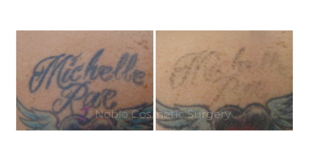LASER-TATTOO-REMOVAL-CASE-00026 | Before and After Laser Tattoo Removal 1