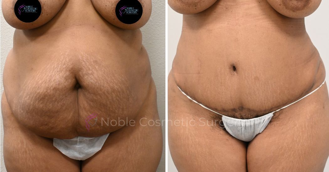 P1-00031A | Before and After Abdominoplasty 1