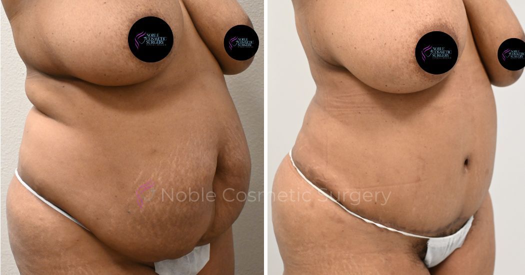 P1-00031A | Before and After Abdominoplasty 2