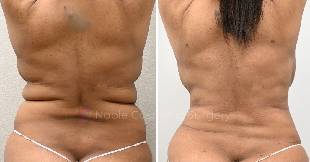 P1-00031A | Before and After Abdominoplasty 3