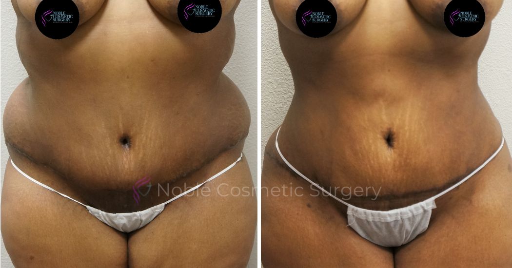 P11-00042A | Before and After Abdominoplasty 1
