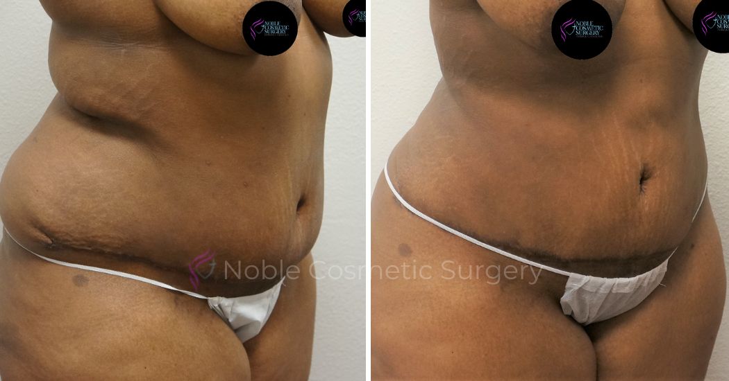 P11-00042A | Before and After Abdominoplasty 2