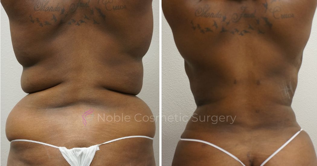 P11-00042A | Before and After Abdominoplasty 3