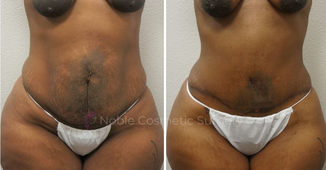 P14-00045A | Before and After Abdominoplasty 1