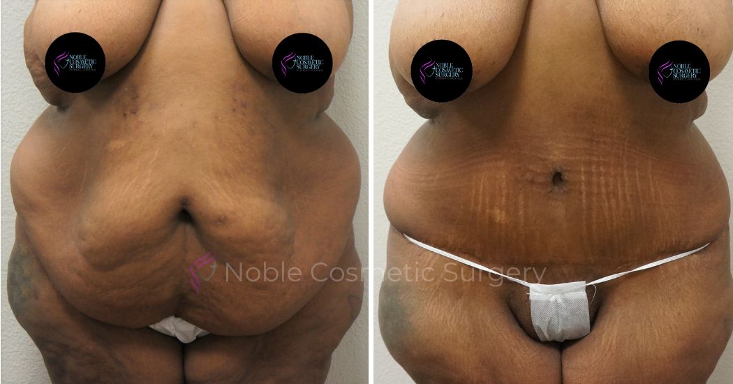 P16-00047A | Before and After Abdominoplasty 1