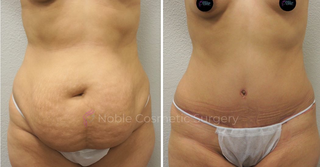 P17-00048A | Before and After Abdominoplasty 1