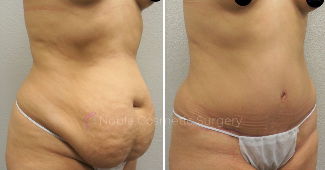 P17-00048A | Before and After Abdominoplasty 2