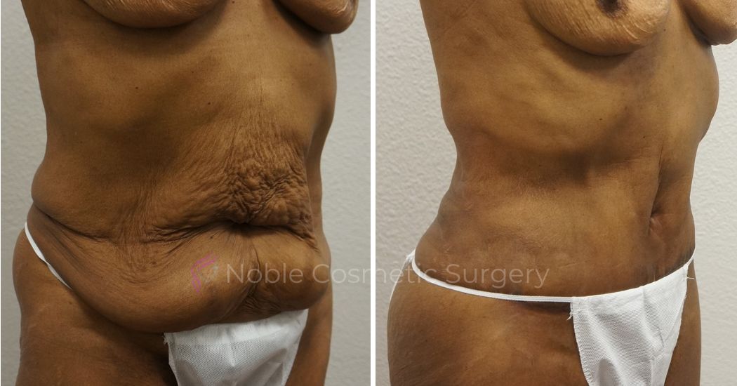 P19-00050A | Before and After Abdominoplasty 1
