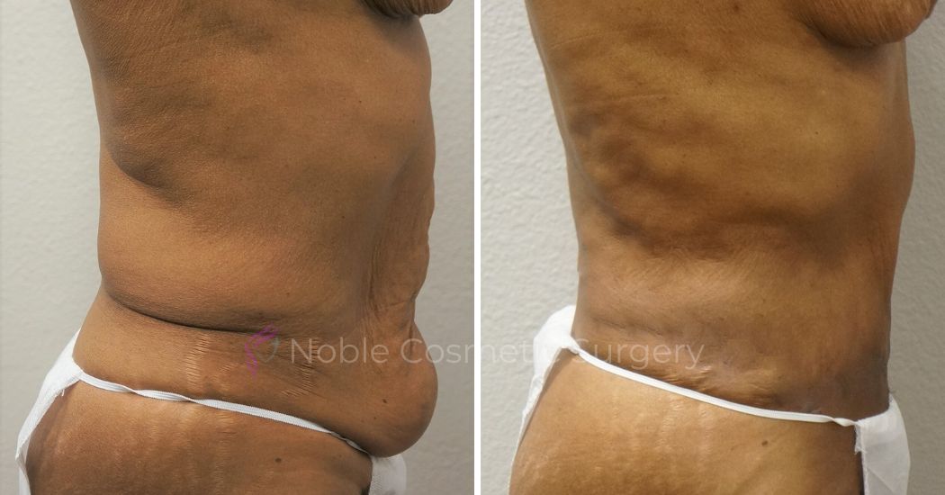 P19-00050A | Before and After Abdominoplasty 2