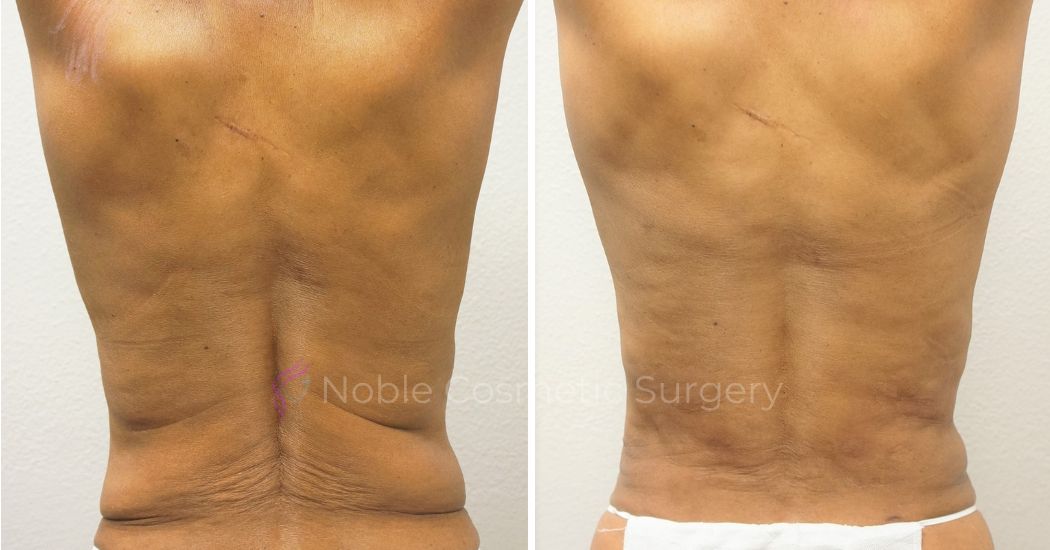 P19-00050A | Before and After Abdominoplasty 3